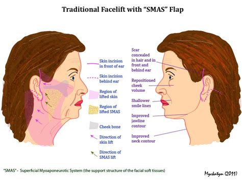 What are differences between traditional and short-scar facelifts?