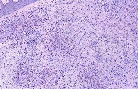 Pathology Outlines - Granuloma faciale