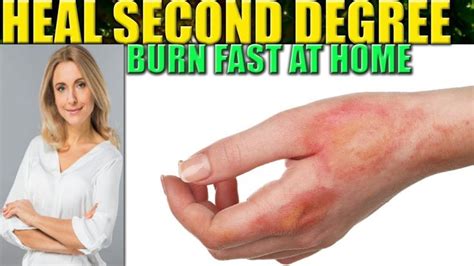 How To Heal A Burn Fast: 2nd Degree Burns Wound Care Home Remedies ...