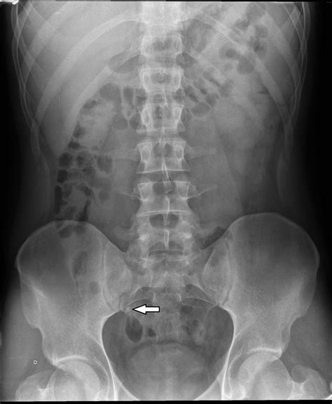 Cureus | Haemangiomas of the Small Intestine: Poorly Known Cause of ...