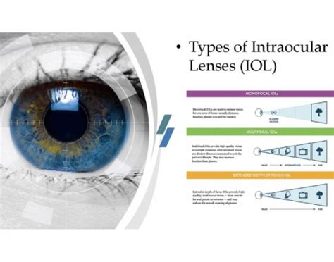 Cataract Surgery: Which Is The Better Lens, Multifocal Or, 40% OFF