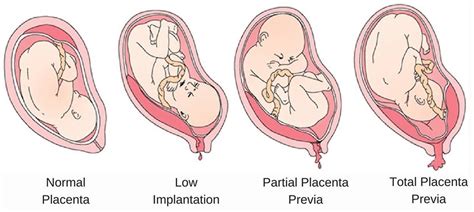 Placenta Previa Causes, Signs, Symptoms, Treatment