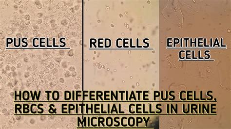 Pus cells,Red blood cells & Epithelial cells seen in urine microscopy.How to differentiate ...