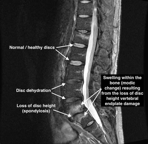 Treatment for Degenerative Disc (spondylosis) | Spine Plus