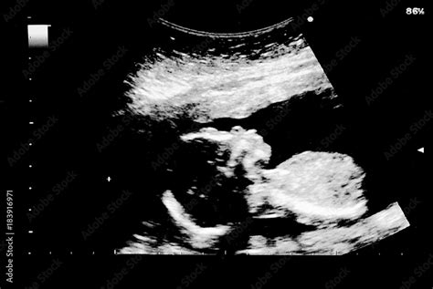 Ultrasound of baby in mother's womb. Stock Photo | Adobe Stock