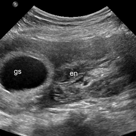 (PDF) Sonographic diagnosis of an interstitial pregnancy in an ...