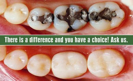 Dental Filling Cost | Composite Dental Fillings Delhi