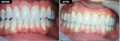 Gum Grafting/Receding Gums Treatment | San Francisco Center for Periodontics and Dental Implants ...