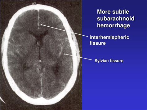 PPT - Critical care of the patient with acute subarachnoid hemorrhage PowerPoint Presentation ...