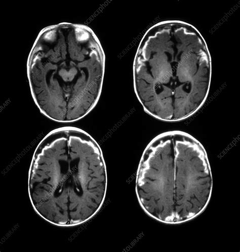 MRI of Meningitis - Stock Image - M210/0404 - Science Photo Library