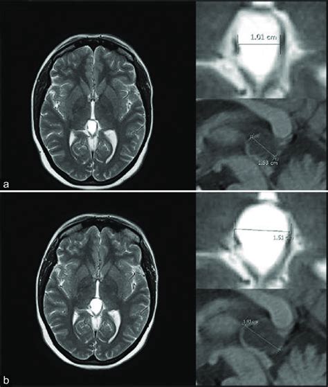 Pineal cyst growth during follow-up, from 1 × 1.5 cm (a) to 1.5 × 1.9... | Download Scientific ...