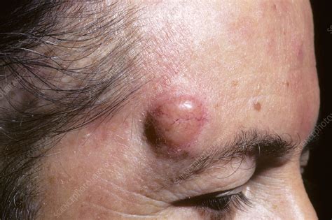 Mycosis fungoides skin cancer - Stock Image - C029/2460 - Science Photo Library