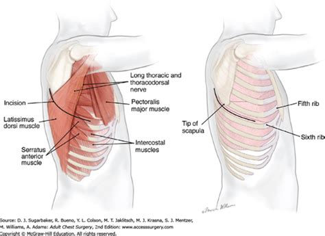 Thoracic Incisions | Thoracic Key