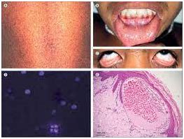 Fabry Disease - Universal Group Of Institutions