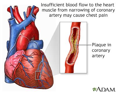 Coronary Artery Spasm - Symptoms and Causes