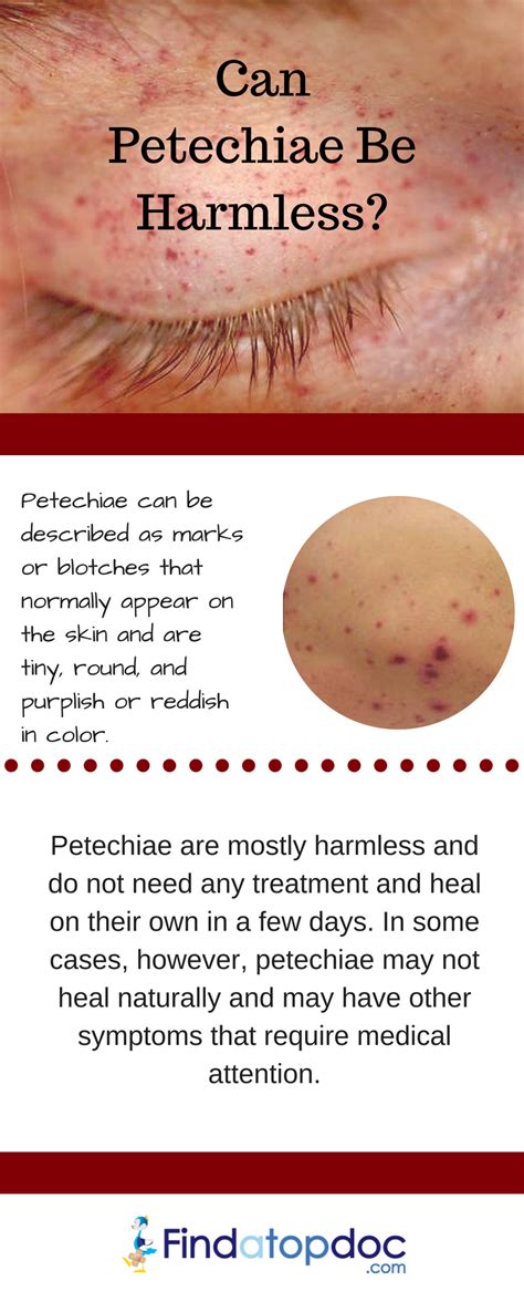 How to Treat Pinpoint Petechiae: 21 Natural Home Remedies