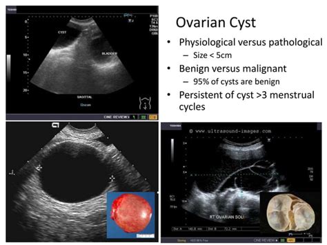 Basic gynae ultrasound