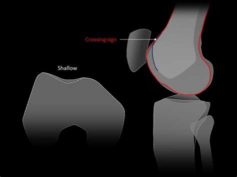 Trochlear Dysplasia - Classification, Symptoms, Treatment