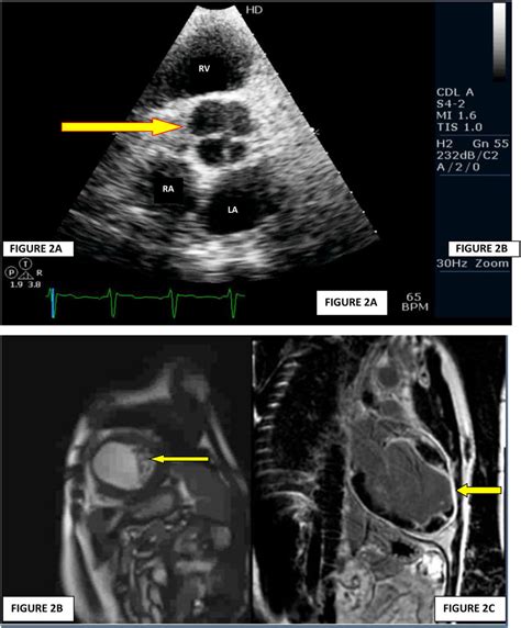 (A) Parasternal short axis view at aortic valve level showing ...