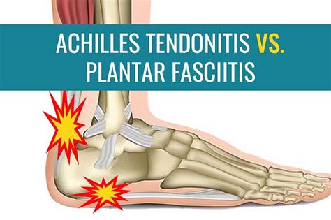 Achilles Tendinitis JOI Jacksonville Orthopaedic Institute, 60% OFF