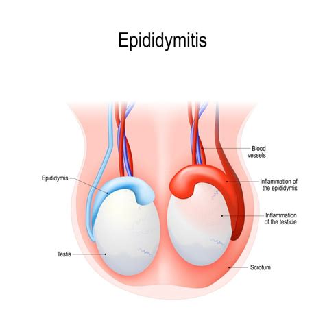 11 Home Remedies For Epididymitis: How To Recover Epididymitis ...