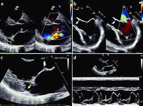 Mitral annular disjunction (MAD) on echocardiography. (a) Transthoracic... | Download Scientific ...