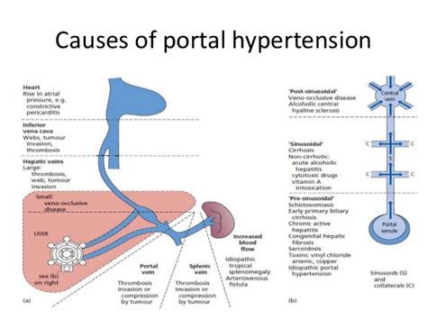 Portal Hypertension