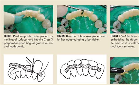 [PDF] Single visit natural tooth pontic bridge with fiber reinforcement ribbon. | Semantic Scholar