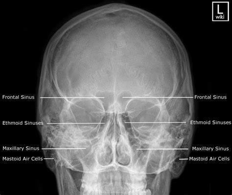 Sinuses Radiographic Anatomy - wikiRadiography