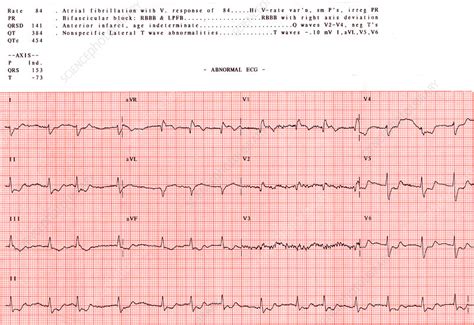 Abnormal EKG - Stock Image - C012/3667 - Science Photo Library