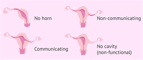 Types of unicornuate uterus