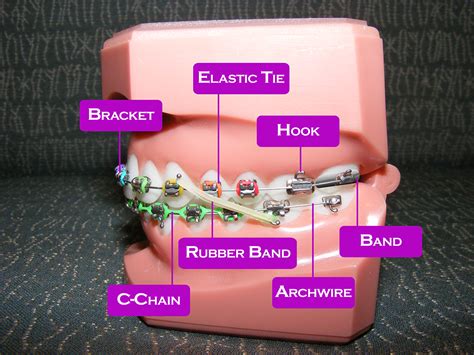 Braces Diagram « Top Concord Orthodontics