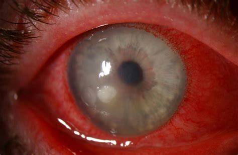 Moran CORE | Bacterial Corneal Ulcer