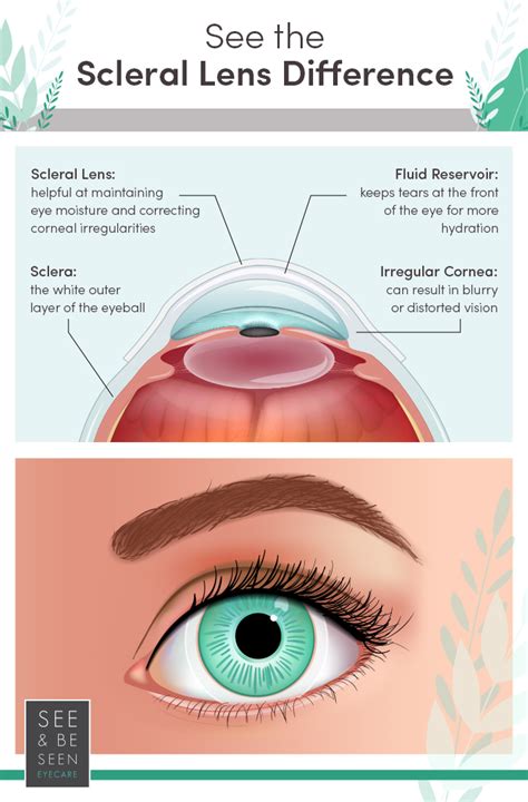 What Is a Scleral Contact Lens? | Toronto, ON | See & Be Seen