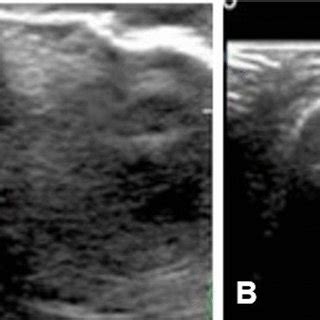 A Ultrasound of the left ankle, displaying reduced peroneus brevis... | Download Scientific Diagram