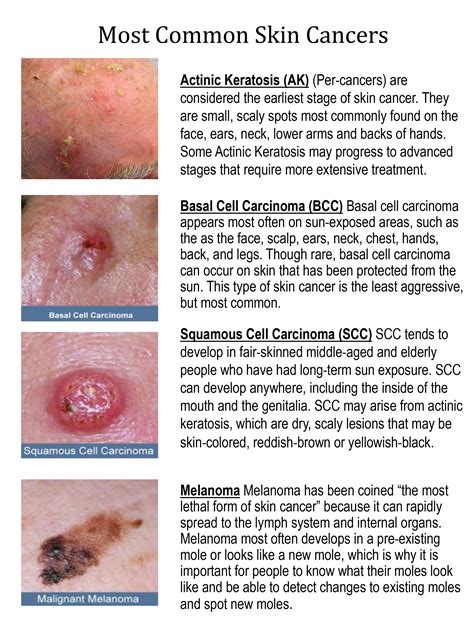 Images Of Different Types Of Skin Cancer