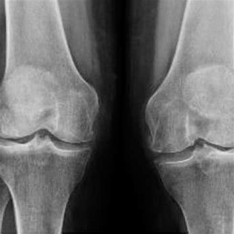 Radiografía de artrosis de rodilla