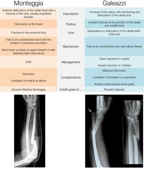 Monteggia vs. Galeazzi fracture | Medical radiography, Medical laboratory science, Radiology imaging