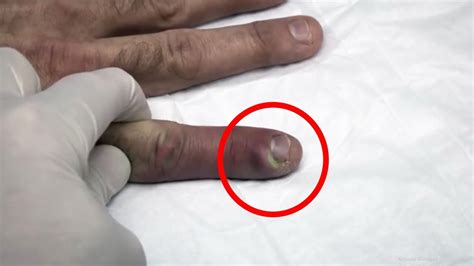 Removal Cyst on finger - Removal blackhead - YouTube