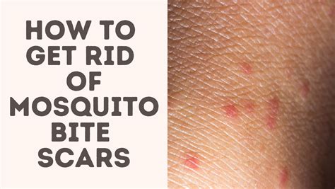 How To Get Rid Of Mosquito Bite Scars - Treat Your Scars