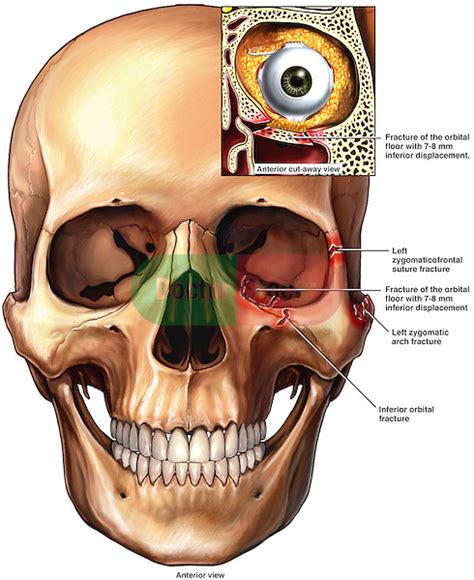 Left Orbital Fractures | Doctor Stock