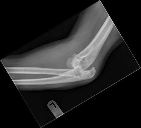 Elbow Dislocation - Trauma - Orthobullets