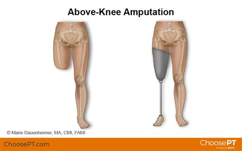 Guide | Physical Therapy Guide to Above-Knee Amputation (Transfemoral ...