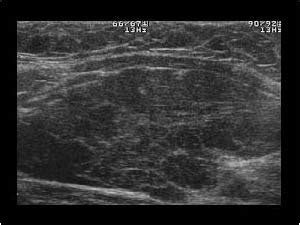 Head and Neck | 4.1 Thyroid gland : Case 4.1.4 Thyroiditis and diffuse thyroid disease ...