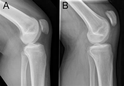 Normal riding patella (A) and patella alta (B). © Mikko Uimonen ...