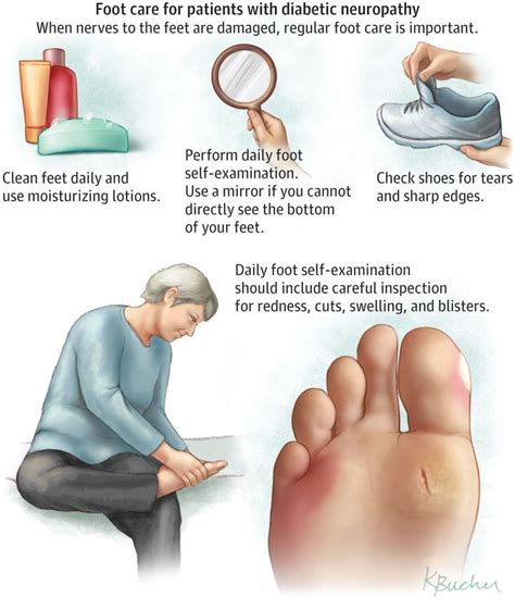 Pin on Neuropathy and "Diabetes"