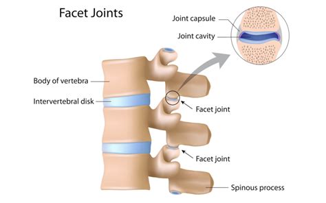 Facet joint syndrome - London Neurosurgery - Spine