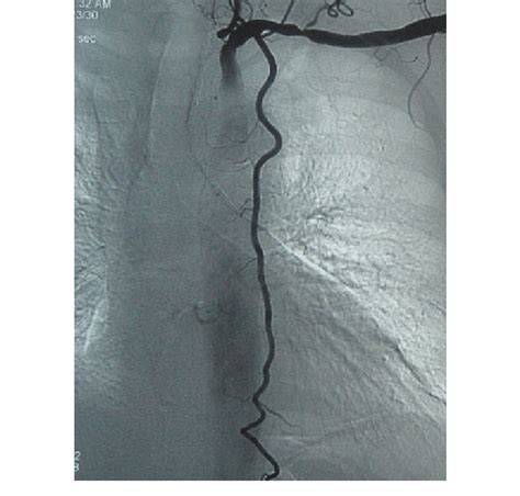 Selective left internal thoracic artery angiogram | Download Scientific Diagram