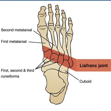 Lisfranc Injuries! The Lisfranc joint is where the metatarsal bones ...