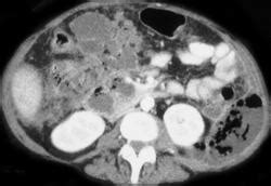 Pancreatic Abscess With Phlegmon - Pancreas Case Studies - CTisus CT Scanning